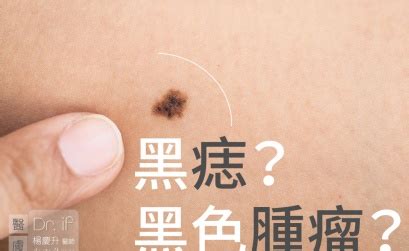 生黑痣|不大驚小怪！如何辨別「黑痣」與「黑色腫瘤」？ 